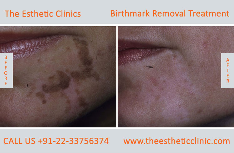Birthmarks Removal Treatment before after photos in mumbai india (4)